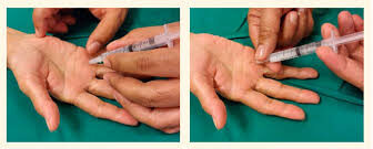שימוש בסטרואידים לטיפול באצבעות הדק