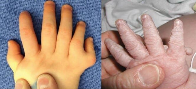 אצבע שארייתית ואצבע מופחתת