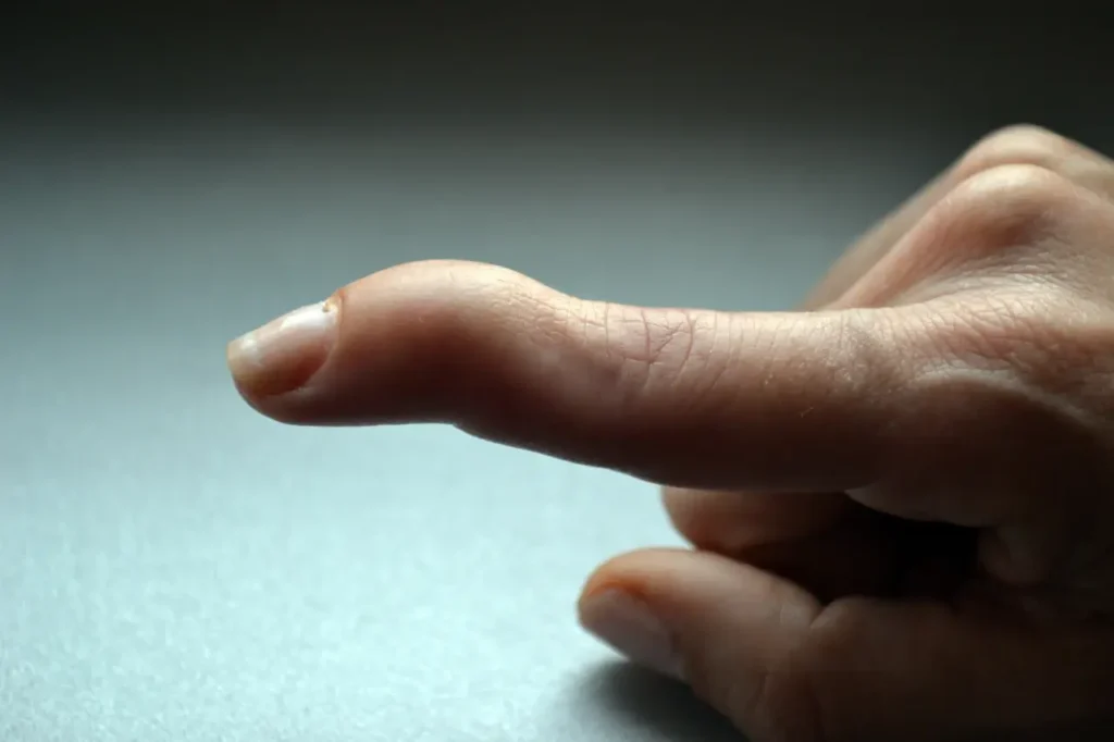 אצבע פטיש (Mallet Finger): למה קצה האצבע נשמט אחרי מכה ומה עושים?